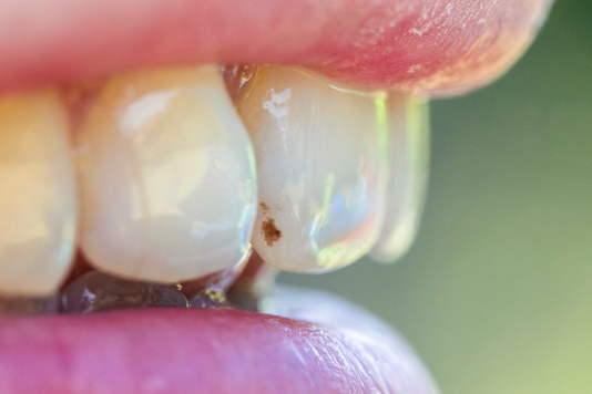 Показания для лечения системой ICON