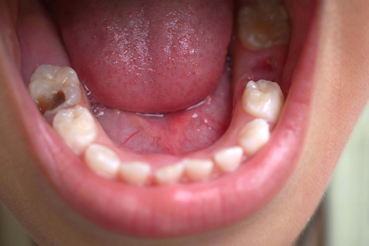 Показания к удалению нерва