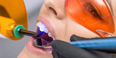 Лечение кариеса