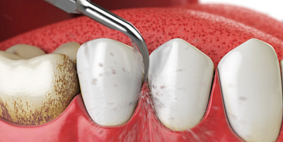 Ультразвуковая чистка зубов