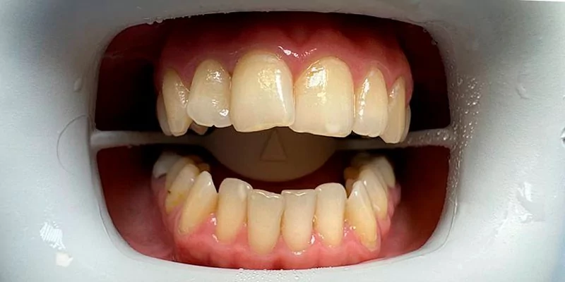 До - Профессиональная чистка зубов